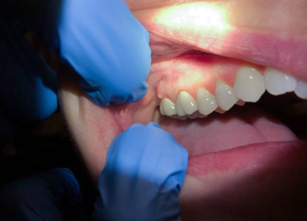 Best Dentist for Tooth Abscess  in Bloomfield, IN